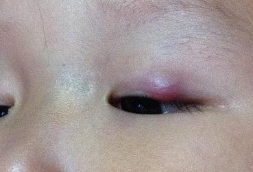 霰粒肿可以吃佛手瓜吗,适宜食用还是需谨慎?